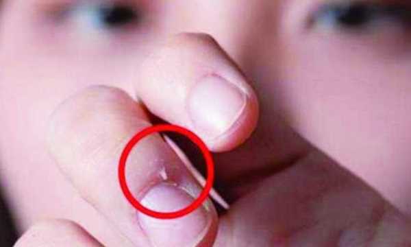 手起倒刺吃什么維生素,手指上長倒刺是因為缺乏維生素嗎圖1