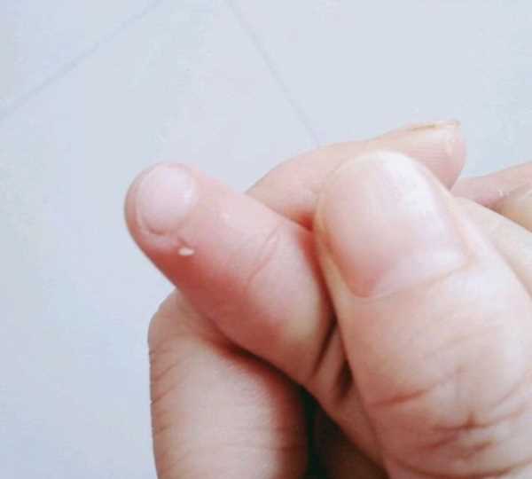 手起倒刺吃什么維生素,手指上長倒刺是因為缺乏維生素嗎圖3