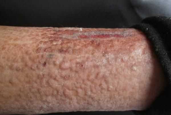 什么是淀粉樣變性腎病