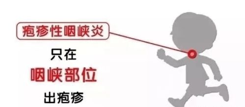 預(yù)防皰疹安全知識