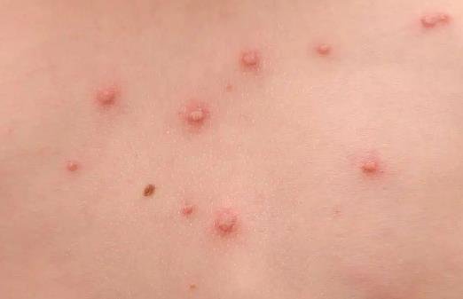 女性hpv真實(shí)圖片