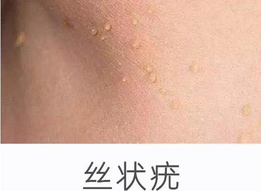 女性hpv真實(shí)圖片