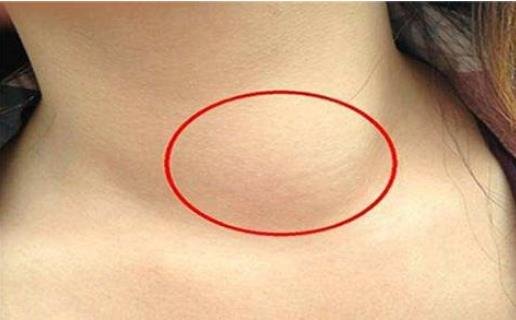 女人艾滋病最明顯特征