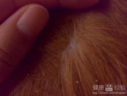 治頭皮屑的有效方法有哪些