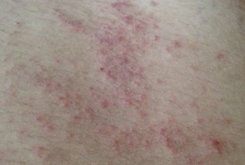 膿狀皰疹的治療方法有哪些日常注意什么