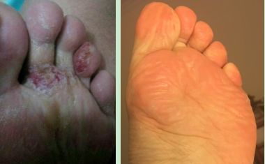 腳氣的根治方法有哪些