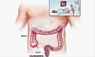 做腸鏡灌腸有哪些方法