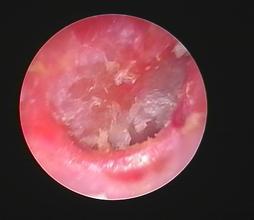 外耳道炎治療有哪些好方法