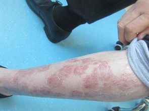 長(zhǎng)春有治療銀屑病的醫(yī)院有哪些方法是什么