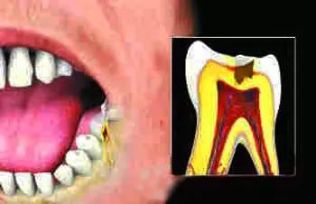 急性智齒冠周炎治療方法有哪些