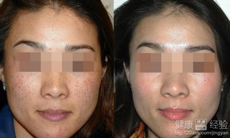 祛斑藥物都有哪些方法有哪些