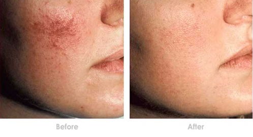 去除面部紅血絲最有效的方法有哪些