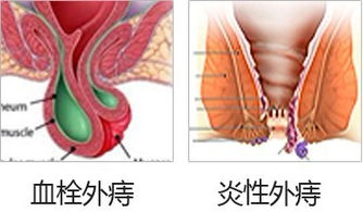 外痔瘡有什么治療的方法有哪些方法有哪些