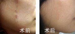 疤痕修復用什么方法有哪些方法