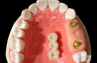 有哪些鑲牙的方法