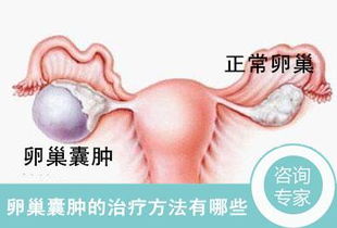 治卵巢囊腫治療的好方法有哪些