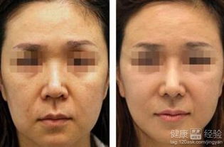 全面部提升有哪些手術方法