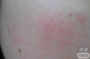 過敏性皮膚病的治療方法有哪些
