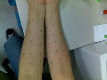 測(cè)過(guò)敏源哪些方法準(zhǔn)確