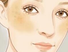 黃褐斑中醫(yī)方法有哪些方法