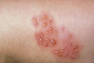 皰疹治療有什么方法有哪些