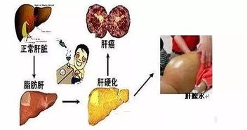 肝硬化腹水一般用哪些治療方法