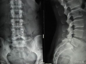 治療椎體滑脫有哪些鍛煉方法