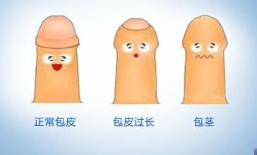 常用包皮過(guò)長(zhǎng)治療方法有哪些