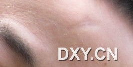 額頭上的舊疤有哪些去除方法