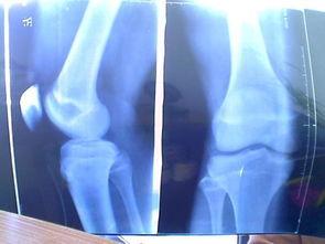 哪些方法促進骨骼發(fā)育