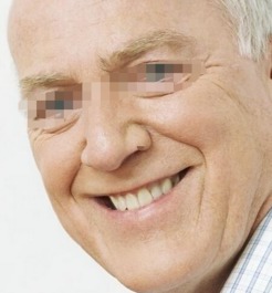 中藥面癱的治療方法有哪些