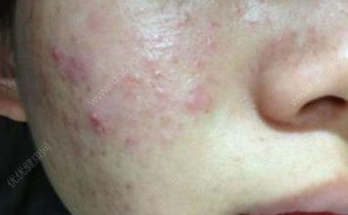 取痘印的方法有哪些