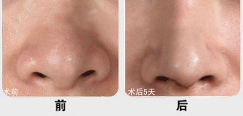 鼻頭縮小術(shù)方法有哪些方法