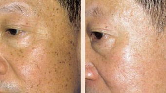 中藥祛老斑方法有哪些