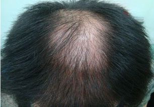 掉頭發(fā)治療好方法有哪些