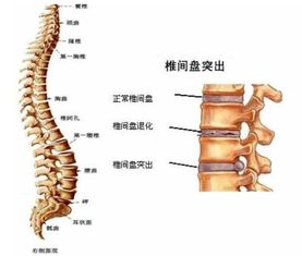 腰椎間盤膨出的治療方法有哪些