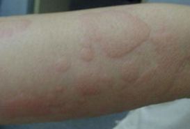 根治蕁麻疹有什么好方法有哪些