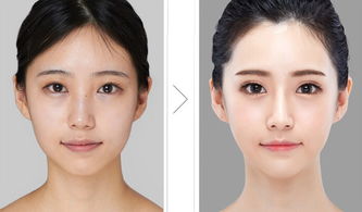 頭面部整形技術(shù)方法有哪些