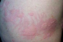 上海治療蕁麻疹的方法有哪些方法