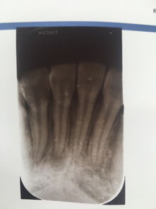 牙根發(fā)炎有哪些治療方法