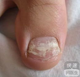 冶療灰指甲方法有哪些