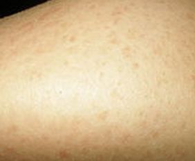 魚鱗病的手護(hù)理方法有哪些