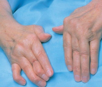 風濕病病的癥狀治療方法有哪些