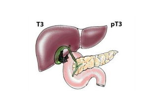 膽囊癌術(shù)后需哪些治療方法