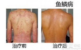 杭州魚鱗病治療方法有哪些