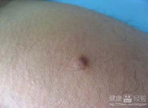 病毒病毒疣有哪些治療方法