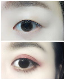 做了雙眼皮怎么恢復(fù)最快方法有哪些問(wèn)題