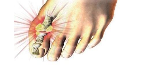 痛風(fēng)的最快的方法有哪些