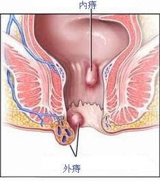痔瘡徹底治療的最佳方法有哪些