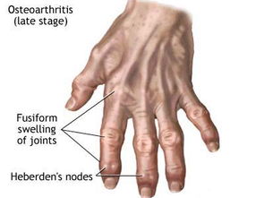 風濕病怎么治最佳方法有哪些